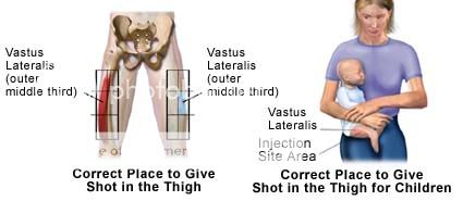 muscle injection areas